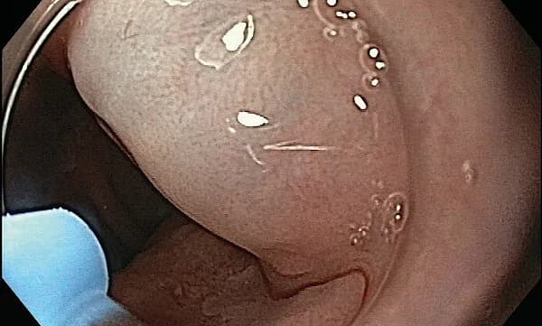 Erbe HybridAPC — Gidroxirurgiya tizimi