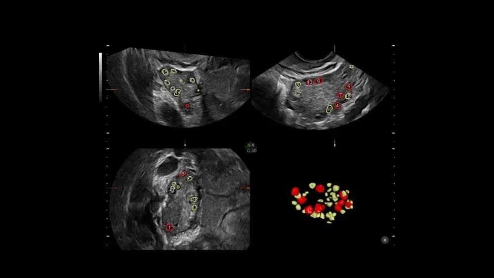 Sonoavc Antral — Ultratovush tizimi