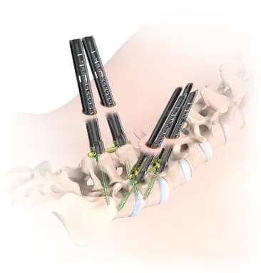 MS MIS Posterior Pedicle Screw System (Cemented) — Ortopediya uskunasi