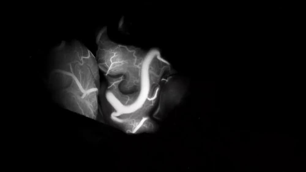 ZEISS Intraoperative Fluorescence Imaging — Intraoperatsion fluoressensiya tasviri
