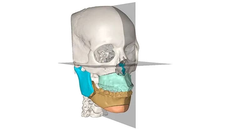 IPS Implants® Transformation — Individual implant yechimi (CMF)