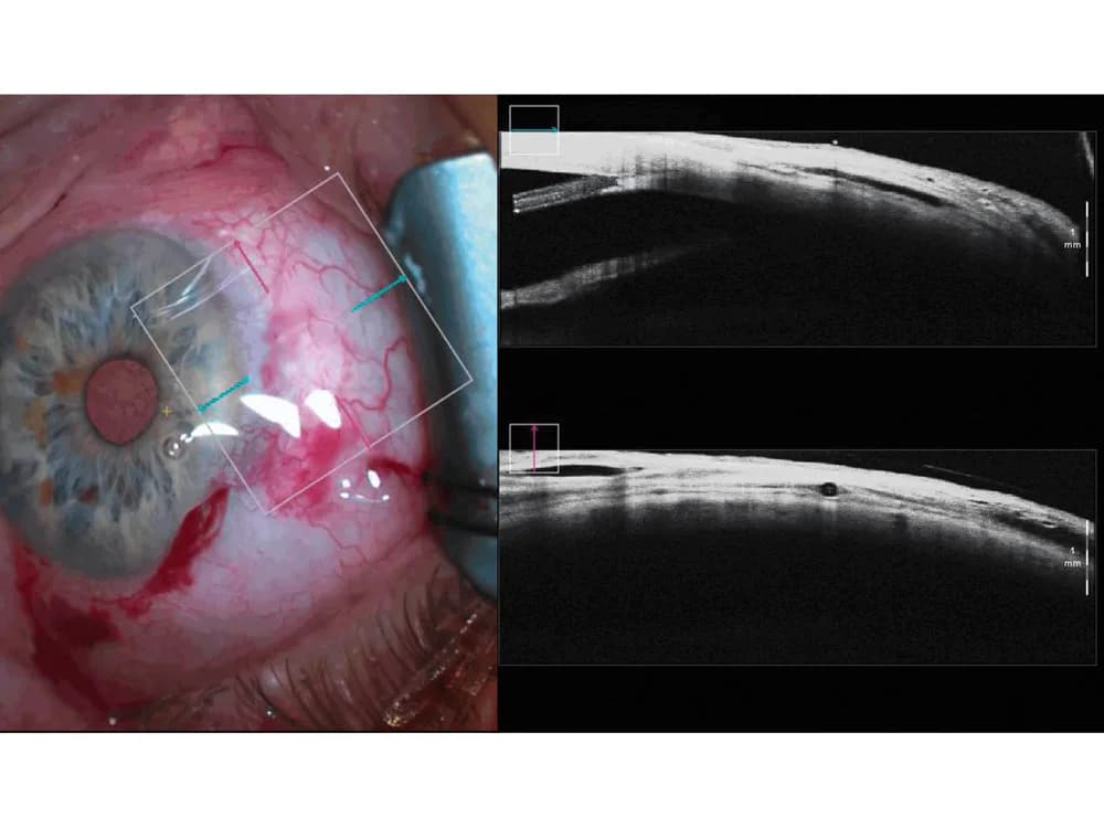 ZEISS OPMI LUMERA 700 ophthalmic microscope — Jarrohlik mikroskopi